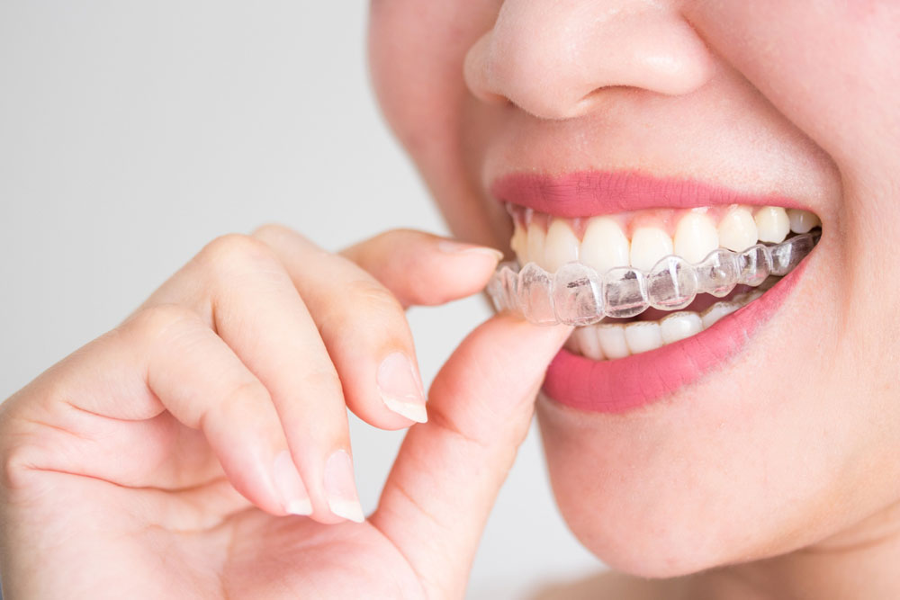 Kieferorthopäde Troisdorf - Pfalzgraf - Invisalign